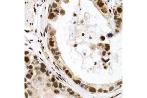 Immunohistochemistry of paraffin-embedded human stomach cancer using MT2A antibody at dilution of 1:200 (400x lens). (MT2A anticorps)