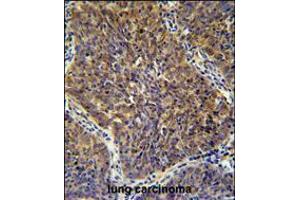 CD2BP2 antibodyimmunohistochemistry analysis in formalin fixed and paraffin embedded human lung carcinoma followed by peroxidase conjugation of the secondary antibody and DAB staining.