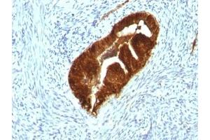 Formalin-fixed, paraffin-embedded human endometrial carcinoma stained with Cytokeratin 19 antibody (KRT19/799 + KRT19/800) (Cytokeratin 19 anticorps)