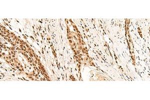 Immunohistochemistry of paraffin-embedded Human esophagus cancer tissue using RMND5B Polyclonal Antibody at dilution of 1:50(x200) (RMND5B anticorps)