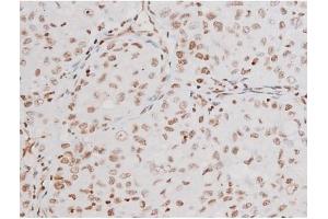 ABIN6267601 at 1/200 staining Human lung cancer tissue sections by IHC-P.
