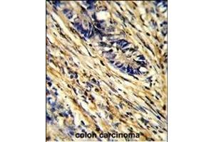 Formalin-fixed and paraffin-embedded human colon carcinoma reacted with YWHAG Antibody (Center), which was peroxidase-conjugated to the secondary antibody, followed by DAB staining.