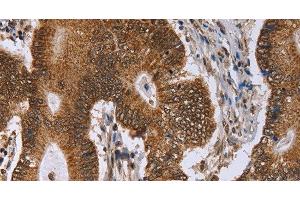 Immunohistochemistry of paraffin-embedded Human colon cancer tissue using ERCC6L Polyclonal Antibody at dilution 1:30 (ERCC6L anticorps)