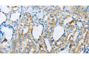 Immunohistochemistry of paraffin-embedded Human thyroid cancer tissue using ARSA Polyclonal Antibody at dilution 1:50 (Arylsulfatase A anticorps)