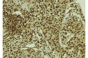 ABIN6278630 at 1/100 staining Human breast cancer tissue by IHC-P. (URI1 anticorps  (Internal Region))