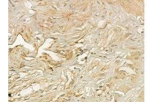 ABIN6258113 and ABIN6273354 at 1/100 staining human testicular cancer by IHC-P. (DIRAS3 anticorps  (C-Term))