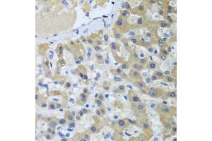 Immunohistochemistry of paraffin-embedded human liver cancer using XPC antibody. (XPC anticorps  (AA 700-940))