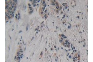 Detection of NSE in Human Breast cancer Tissue using Polyclonal Antibody to Enolase, Neuron Specific (NSE)