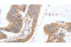 Immunohistochemistry of paraffin-embedded Human colon cancer tissue using TGFA Polyclonal Antibody at dilution 1:60 (TGFA anticorps)