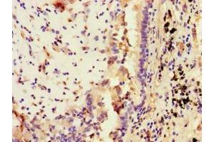 Immunohistochemistry of paraffin-embedded human lung cancer using ABIN7169671 at dilution of 1:100