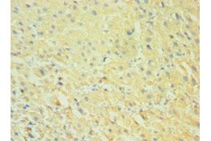 Immunohistochemistry of paraffin-embedded human liver cancer using ABIN7146296 at dilution of 1:100 (CALHM1 anticorps  (AA 202-346))