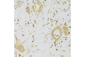 Immunohistochemistry of paraffin-embedded human liver cancer using CASP2 Antibody. (Caspase 2 anticorps  (AA 153-452))