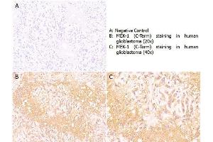 Immunohistochemistry with anti-MEK1 (C-Term) antibody showing positive staining in human glioblastoma tissue at 20x and 40x (B & C).