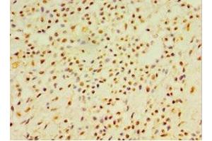 Immunohistochemistry of paraffin-embedded human breast cancer using ABIN7145488 at dilution of 1:100 (DEFB4A anticorps  (AA 1-64))