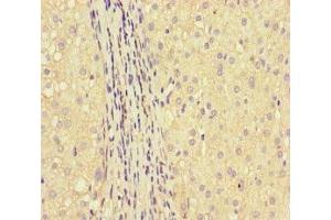 Immunohistochemistry of paraffin-embedded human liver cancer using ABIN7154022 at dilution of 1:100