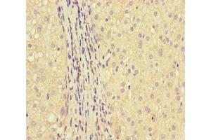Immunohistochemistry of paraffin-embedded human liver cancer using ABIN7154022 at dilution of 1:100 (GLUL anticorps  (AA 86-373))