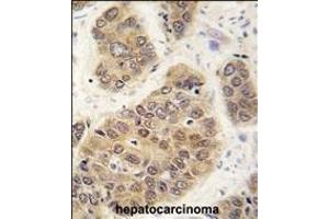 Formalin-fixed and paraffin-embedded human hepatocarcinoma tissue reacted with SUMO4 antibody (M55 Wild type) (ABIN388078 and ABIN2845840) , which was peroxidase-conjugated to the secondary antibody, followed by DAB staining.