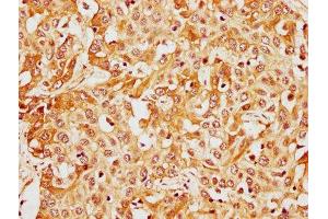 IHC image of ABIN7148386 diluted at 1:400 and staining in paraffin-embedded human liver cancer performed on a Leica BondTM system.