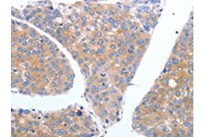 The image on the left is immunohistochemistry of paraffin-embedded Human breast cancer tissue using ABIN7190790(GFRA4 Antibody) at dilution 1/40, on the right is treated with synthetic peptide.