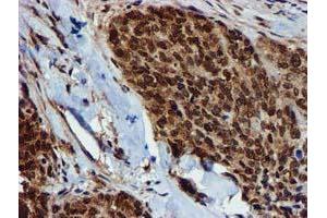 Immunohistochemical staining of paraffin-embedded Adenocarcinoma of Human breast tissue using anti-GSTT2 mouse monoclonal antibody. (GSTT2 anticorps)