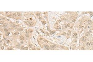 Immunohistochemistry of paraffin-embedded Human esophagus cancer tissue using RSU1 Polyclonal Antibody at dilution of 1:30(x200)