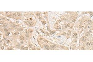 Immunohistochemistry of paraffin-embedded Human esophagus cancer tissue using RSU1 Polyclonal Antibody at dilution of 1:30(x200) (RSU1 anticorps)