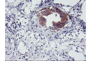 Immunohistochemical staining of paraffin-embedded Carcinoma of Human pancreas tissue using anti-NMT2 mouse monoclonal antibody. (NMT2 anticorps)
