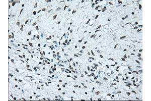 Immunohistochemical staining of paraffin-embedded Adenocarcinoma of colon tissue using anti-BRAFmouse monoclonal antibody. (BRAF anticorps)