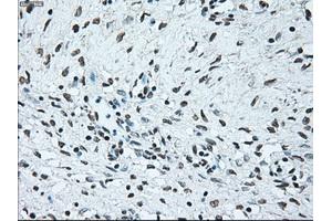 Immunohistochemical staining of paraffin-embedded Adenocarcinoma of colon tissue using anti-BRAFmouse monoclonal antibody. (BRAF anticorps)