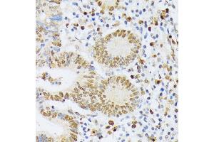 Immunohistochemistry of paraffin-embedded human colon carcinoma using EL antibody (ABIN6132052, ABIN6140108, ABIN6140109 and ABIN6222942) at dilution of 1:200 (40x lens). (ELAC2 anticorps  (AA 1-270))
