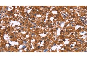 Immunohistochemistry of paraffin-embedded Human thyroid cancer tissue using HLTF Polyclonal Antibody at dilution 1:30 (HLTF anticorps)