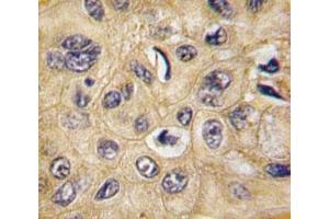IHC analysis of FFPE human hepatocarcinoma tissue stained with Tuberin antibody (Tuberin anticorps  (AA 1776-1805))