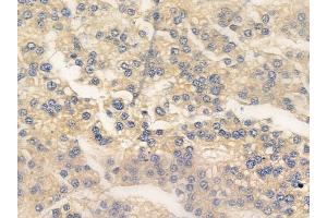ABIN6255950 and ABIN6267275 at 1/100 staining human hepatocellular carcinoma by IHC-P. (Estrogen Receptor alpha anticorps  (pTyr537))
