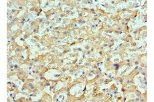 Immunohistochemistry of paraffin-embedded human liver cancer using ABIN7154901 at dilution of 1:100
