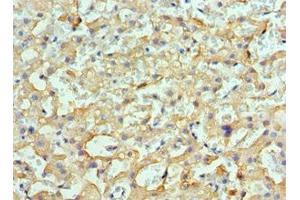 Immunohistochemistry of paraffin-embedded human liver cancer using ABIN7154901 at dilution of 1:100 (HSPH1 anticorps  (AA 659-858))