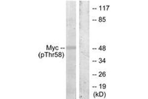 Western blot analysis of extracts from ovary cancer, using Myc (Phospho-Thr58) Antibody. (c-MYC anticorps  (pThr58))