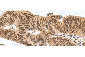 Immunohistochemistry of paraffin-embedded Human colorectal cancer tissue using FBXO32 Polyclonal Antibody at dilution of 1:60(x200) (FBXO32 anticorps)