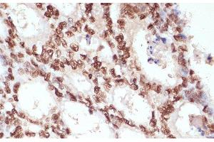 Immunohistochemistry of paraffin-embedded Human colon carcinoma using Phospho-β-catenin(S33/S37/T41) Polyclonal Antibody at dilution of 1:100 (40x lens).