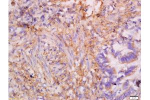 Formalin-fixed and paraffin embedded human lung carcinoma labeled with Anti-CK7 Polyclonal Antibody, Unconjugated  at 1:300 followed by conjugation to the secondary antibody and DAB staining. (Cytokeratin 7 anticorps  (AA 251-350))