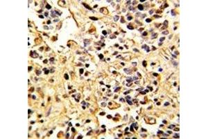 IHC analysis of FFPE human kidney carcinoma with Neprilysin antibody