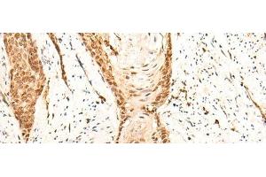 Immunohistochemistry of paraffin-embedded Human esophagus cancer tissue using EMSY Polyclonal Antibody at dilution of 1:25(x200) (EMSY anticorps)