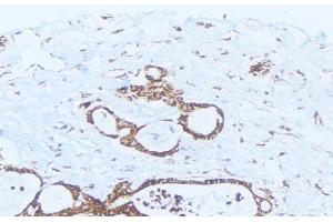 ABIN6275413 at 1/100 staining Human lung cancer tissue by IHC-P. (PPM1K anticorps  (Internal Region))