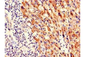 Immunohistochemistry of paraffin-embedded human liver cancer using ABIN7169149 at dilution of 1:100
