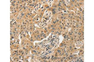 Immunohistochemistry of Human esophagus cancer using SLC11A2 Polyclonal Antibody at dilution of 1:50 (SLC11A2 anticorps)