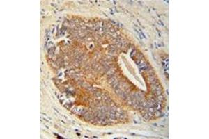 Immunohistochemistry analysis in formalin fixed and paraffin embedded human prostate carcinoma reacted with GAGE7 Antibody (C-term) followed by peroxidase conjugation of the secondary antibody and DAB staining. (G Antigen 7 anticorps  (C-Term))