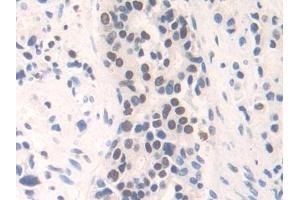 Detection of FAM19A3 in Human Prostate cancer Tissue using Polyclonal Antibody to Family With Sequence Similarity 19, Member A3 (FAM19A3)