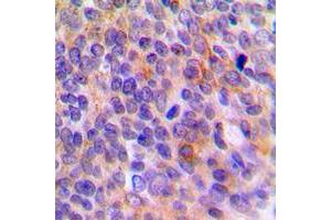 Immunohistochemical analysis of TOLLIP staining in human breast cancer formalin fixed paraffin embedded tissue section.