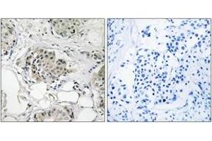 Immunohistochemistry analysis of paraffin-embedded human breast carcinoma tissue, using USP13 Antibody. (USP13 anticorps  (AA 811-860))