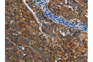 The image on the left is immunohistochemistry of paraffin-embedded Human ovarian cancer tissue using ABIN7129016(COX6B2 Antibody) at dilution 1/50, on the right is treated with fusion protein. (COX6B2 anticorps)