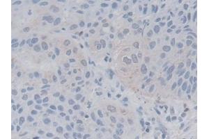 Detection of LACTb in Human Lung cancer Tissue using Polyclonal Antibody to Lactamase Beta (LACTb)